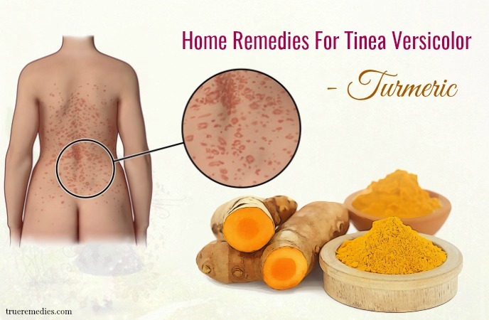 home remedies for tinea versicolor - turmeric