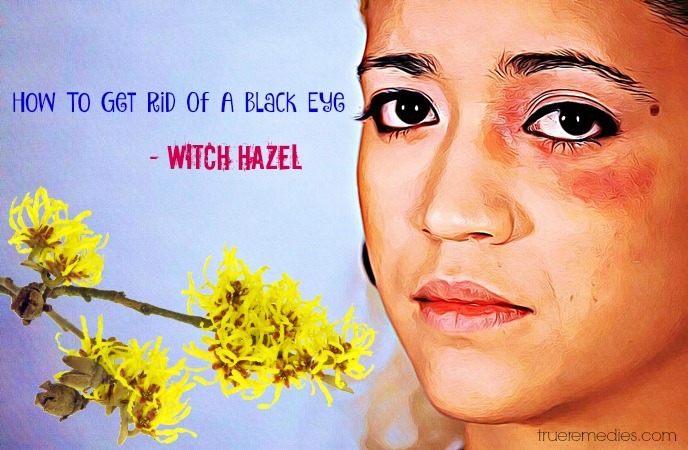 how to get rid of a black eye - witch hazel