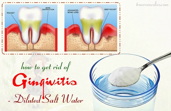 how to get rid of gingivitis - diluted salt water