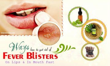 tips on how to get rid of fever blisters