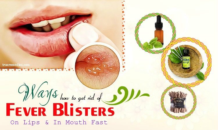 19 Ways How To Get Rid Of Fever Blisters On Lips In Mouth Fast