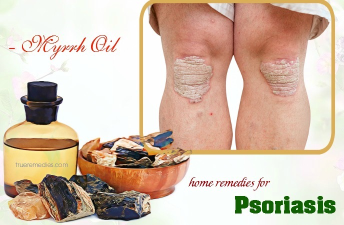 25 Home Remedies For Psoriasis On Face Hands Legs And Scalp 