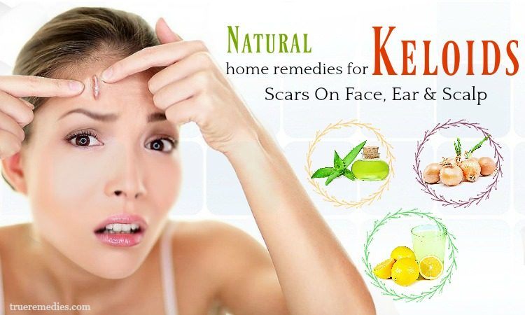 home remedies for keloids on face