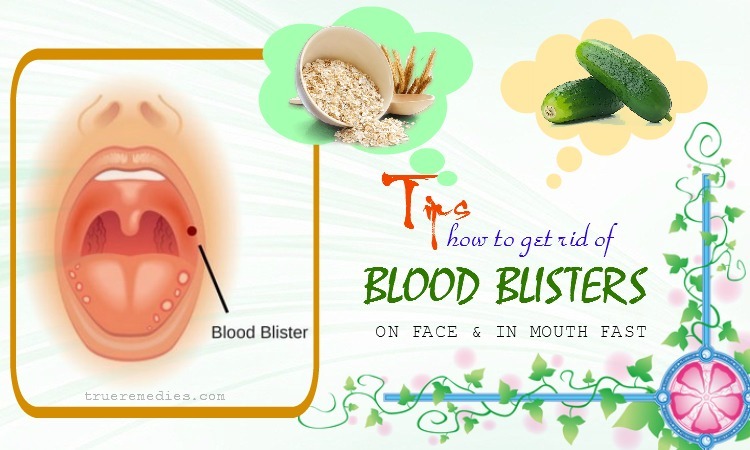 how to get rid of blood blisters in mouth