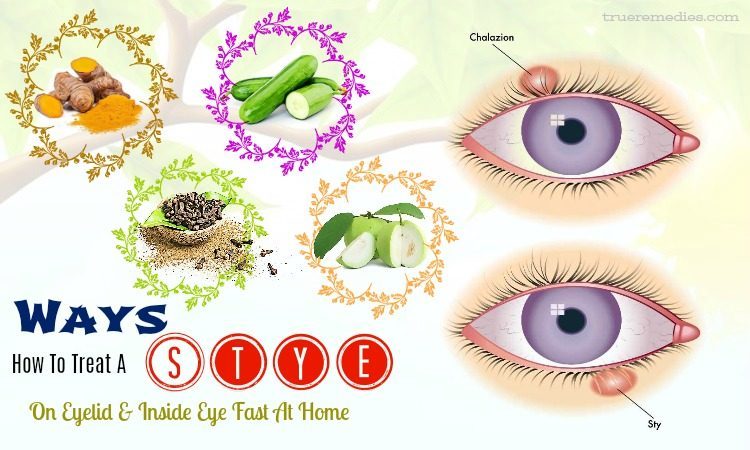 tips on how to treat a stye