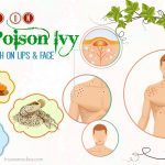how to treat poison ivy rash