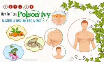 how to treat poison ivy rash