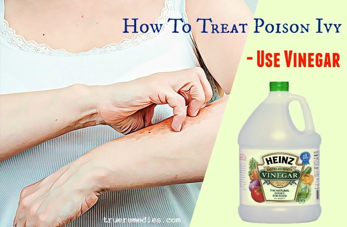 how to treat poison ivy blisters - use vinegar