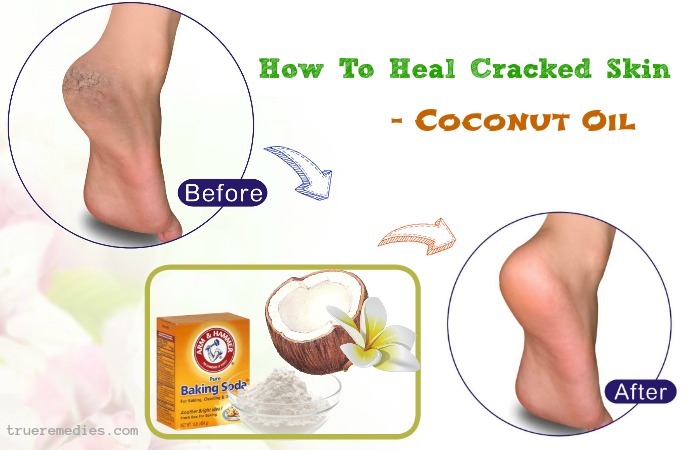 how to heal cracked skin on hands - coconut oil
