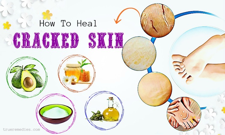 how to heal cracked skin on hands