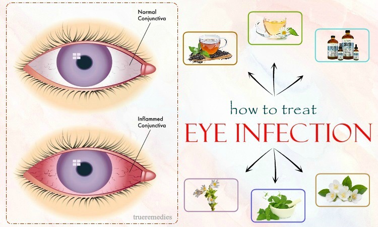 tips on how to treat eye infection