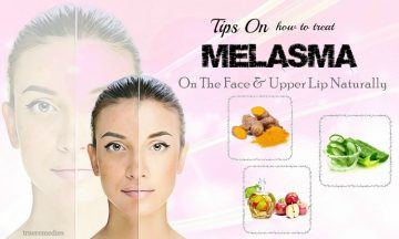 how to treat melasma on upper lip