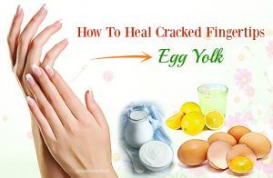 19 Tips How To Heal Cracked Fingertips Fast At Home