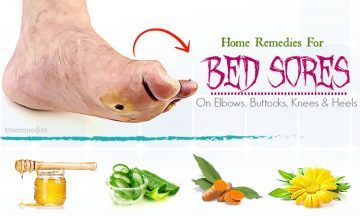 natural home remedies for bed sores