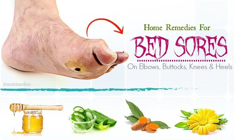 16-home-remedies-for-bed-sores-on-elbows-buttocks-knees-heels