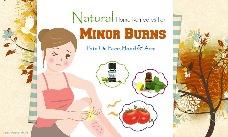 natural home remedies for minor burns