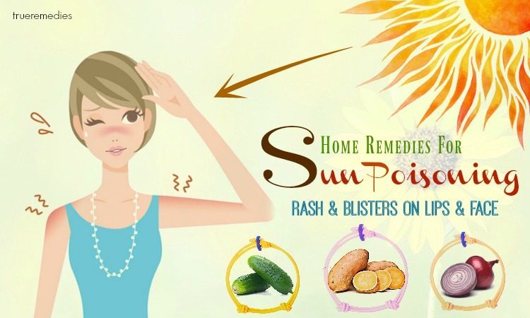 home remedies for sun poisoning blisters