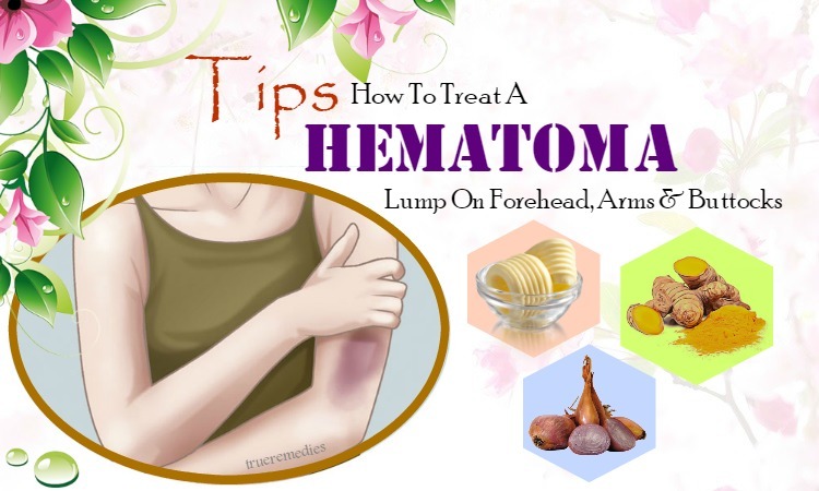 how to treat a hematoma lump