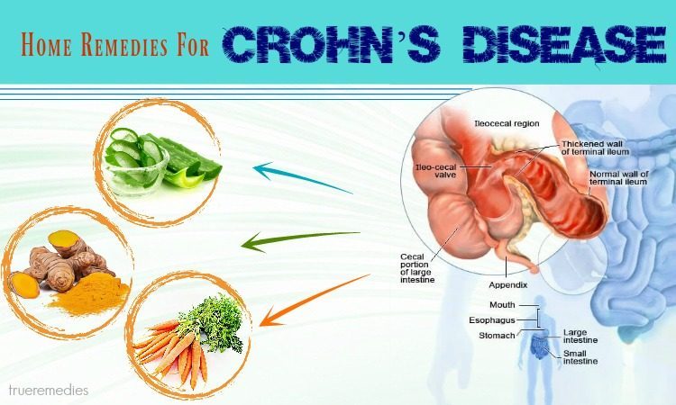 home remedies for crohn’s disease relief