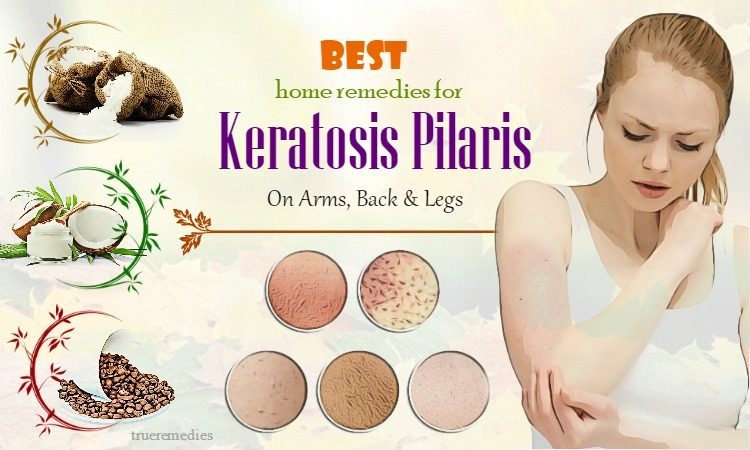 home remedies for keratosis pilaris on arms