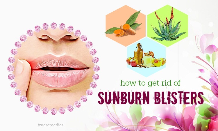 how to get rid of sunburn blisters on lips
