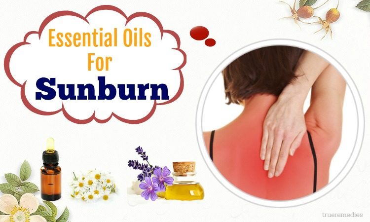 natural essential oils for sunburn