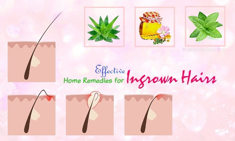 home remedies for ingrown hairs