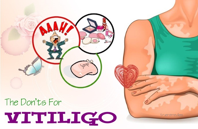 vitiligo do's and don'ts - the don’ts for vitiligo