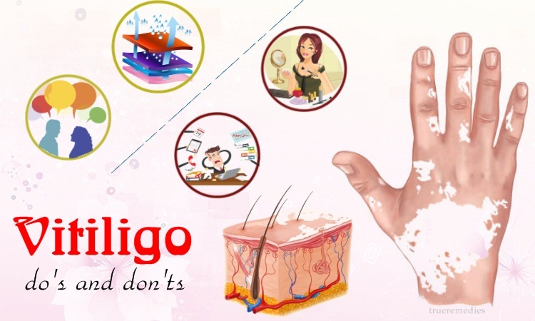 top vitiligo do's and don'ts