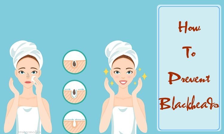 how to prevent blackheads naturally
