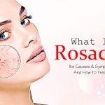 what is rosacea? how to treat it