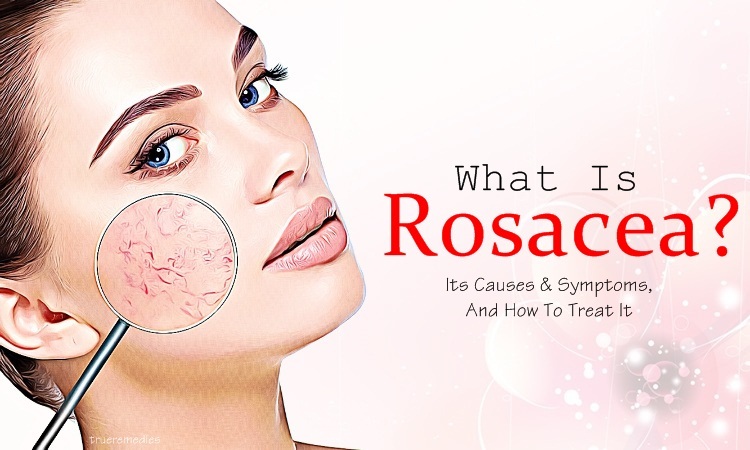 what is rosacea? how to treat it