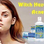 witch hazel for acne treatment