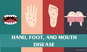 hand, foot, and mouth disease in children