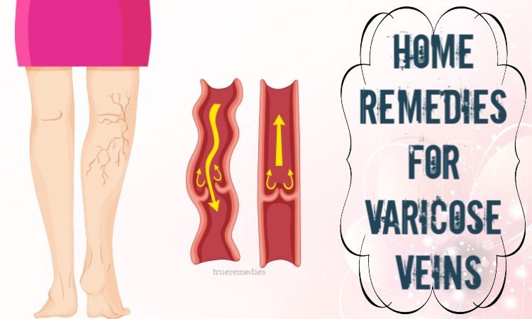 natural home remedies for varicose veins